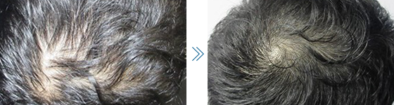写真：39歳男性 皮脂の分泌が少なくなり髪質、肌質も改善 Before After
